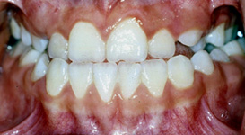Kopfbissfrontal Kopfbissfrontal