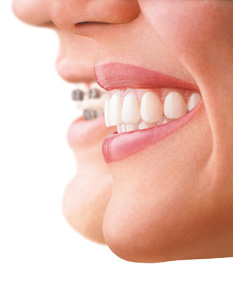 Profiles_Braces+Aligner