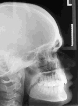 Fernröntgenbild (FRS) beim Kieferorthopäden