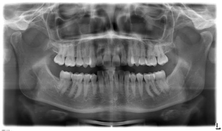 Panorama-Röntgenbild erstellt beim Kieferorthopäden