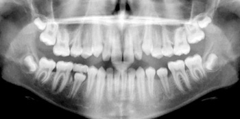 Panorama-Röntgenbild (spätes Wechselgebiss) von der Kfo Praxis Hamburg Hamm erstellt